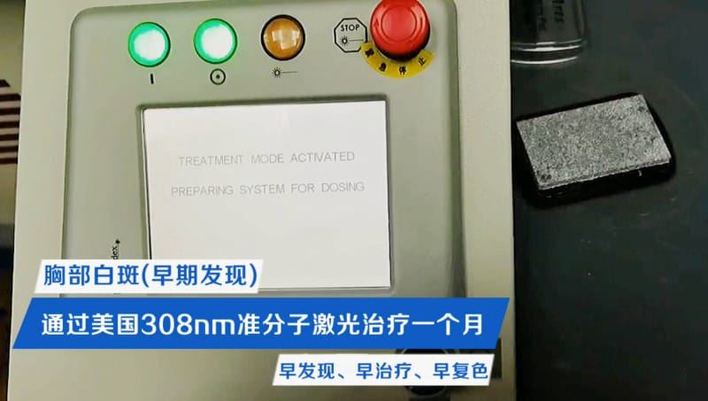 颈部的白癜风有什么影响